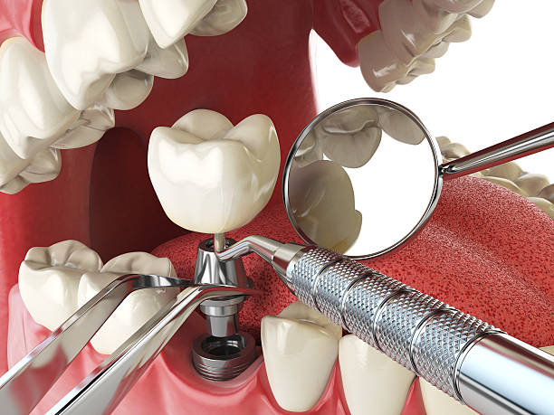 Best Urgent Tooth Repair  in Royal Palm Beach, FL